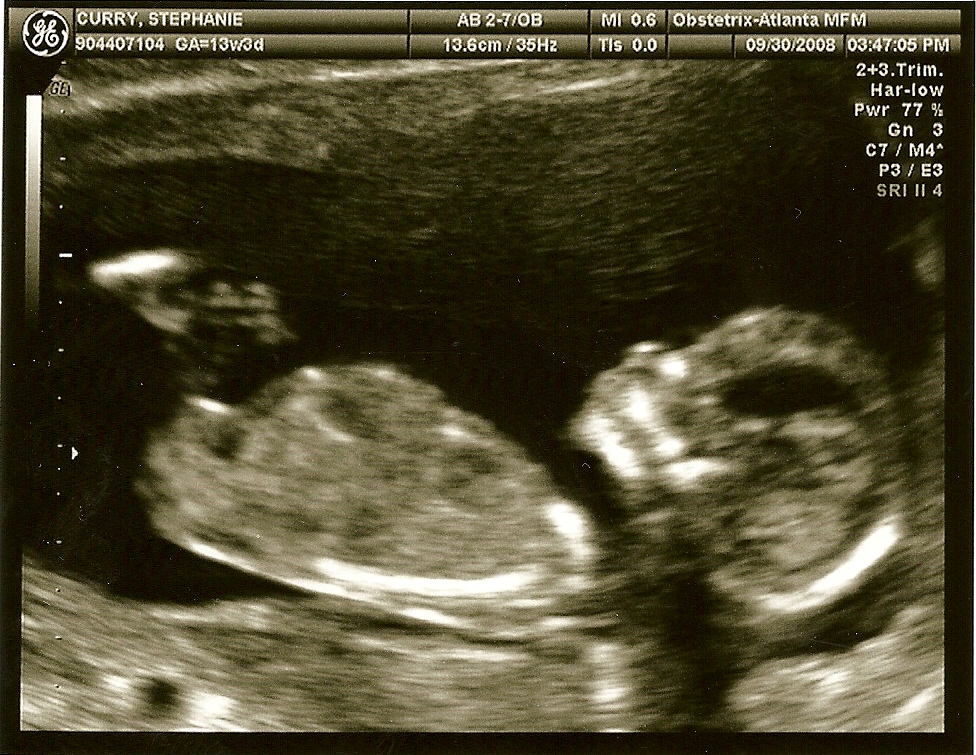 ultrasounds at 13 weeks. 13 weeks, 4 days – ultrasound